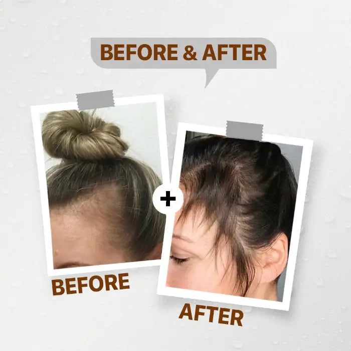 Anti-HairLoss Ampoules